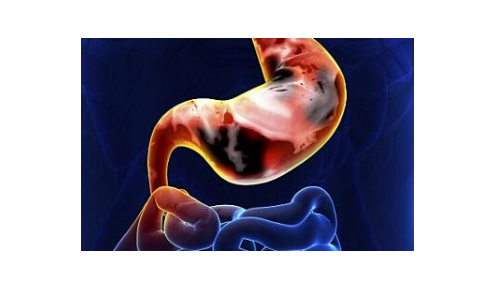 胃炎的癥狀及治療方法，怎么治療常見的慢性胃炎呢